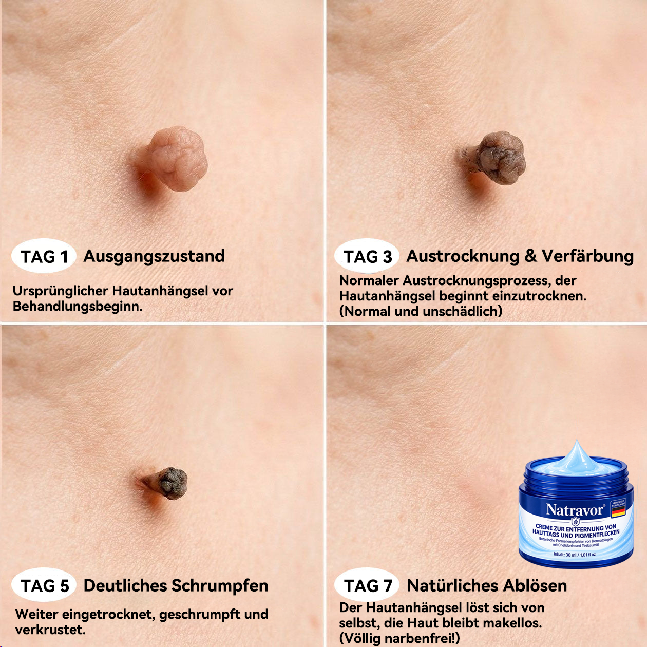 Natravor® 𝟕-𝐓𝐚𝐠𝐞 𝐇𝐚𝐮𝐭𝐚𝐧𝐡ä𝐧𝐠𝐬𝐞𝐥- & 𝐅𝐥𝐞𝐜𝐤𝐞𝐧-𝐄𝐧𝐭𝐟𝐞𝐫𝐧𝐮𝐧𝐠𝐬𝐜𝐫𝐞𝐦𝐞 (𝐒𝐜𝐡𝐦𝐞𝐫𝐳𝐟𝐫𝐞𝐢𝐞 𝐅𝐨𝐫𝐦𝐞𝐥 – 𝐨𝐡𝐧𝐞 𝐍𝐚𝐫𝐛𝐞𝐧) 🎉c