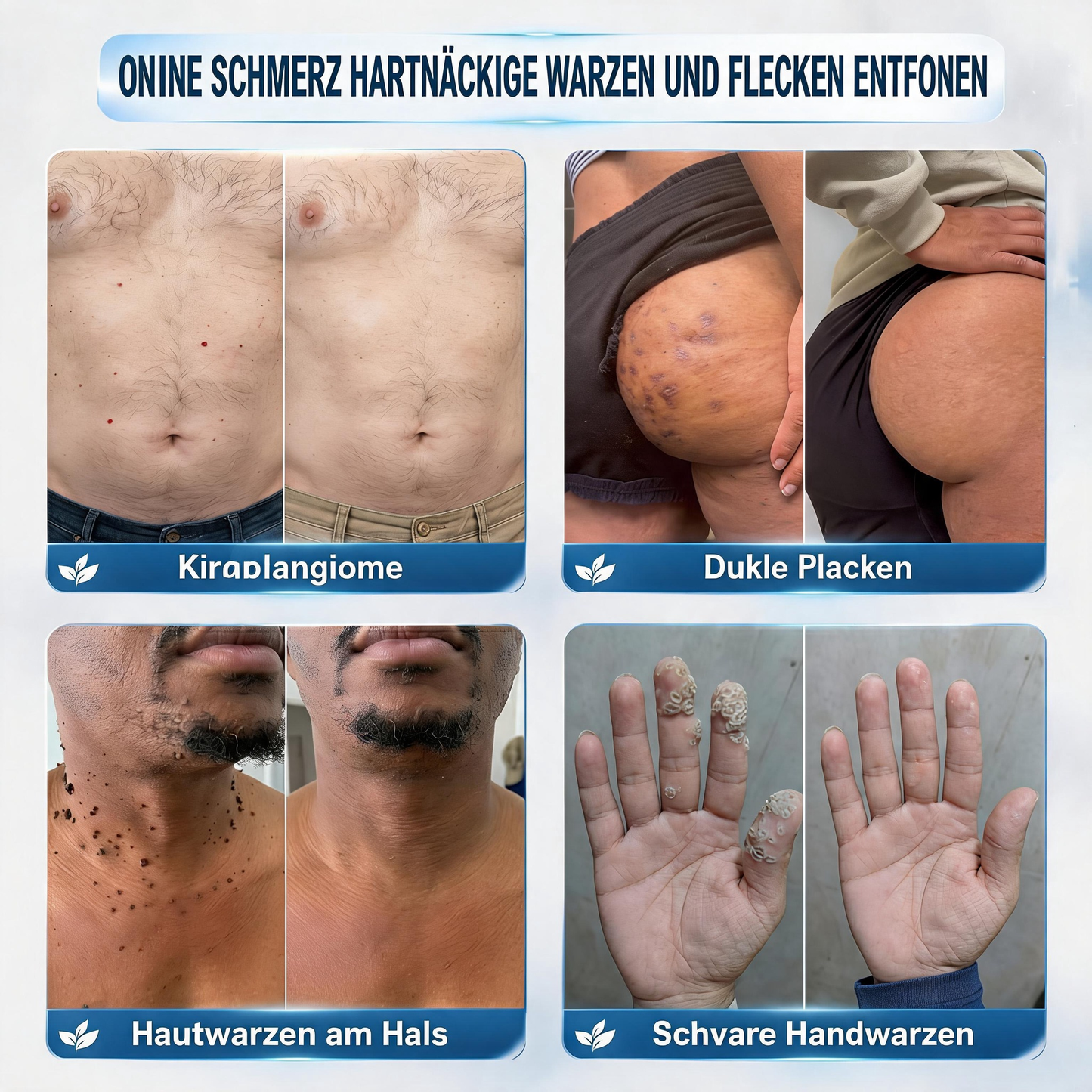 Natravor® 𝟕-𝐓𝐚𝐠𝐞 𝐇𝐚𝐮𝐭𝐚𝐧𝐡ä𝐧𝐠𝐬𝐞𝐥- & 𝐅𝐥𝐞𝐜𝐤𝐞𝐧-𝐄𝐧𝐭𝐟𝐞𝐫𝐧𝐮𝐧𝐠𝐬𝐜𝐫𝐞𝐦𝐞 (𝐒𝐜𝐡𝐦𝐞𝐫𝐳𝐟𝐫𝐞𝐢𝐞 𝐅𝐨𝐫𝐦𝐞𝐥 – 𝐨𝐡𝐧𝐞 𝐍𝐚𝐫𝐛𝐞𝐧) 🎉c
