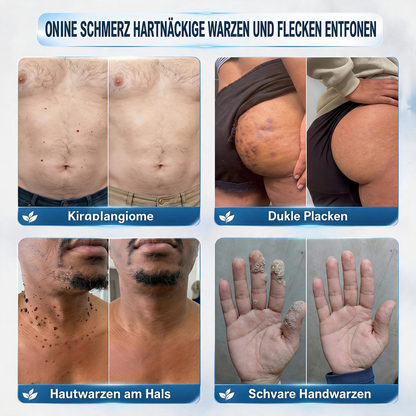 Natravor® 𝟕-𝐓𝐚𝐠𝐞 𝐇𝐚𝐮𝐭𝐚𝐧𝐡ä𝐧𝐠𝐬𝐞𝐥- & 𝐅𝐥𝐞𝐜𝐤𝐞𝐧-𝐄𝐧𝐭𝐟𝐞𝐫𝐧𝐮𝐧𝐠𝐬𝐜𝐫𝐞𝐦𝐞 (𝐒𝐜𝐡𝐦𝐞𝐫𝐳𝐟𝐫𝐞𝐢𝐞 𝐅𝐨𝐫𝐦𝐞𝐥 – 𝐨𝐡𝐧𝐞 𝐍𝐚𝐫𝐛𝐞𝐧) 🎉c